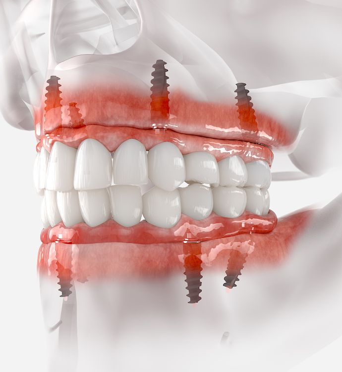 Visų dantų atkūrimas ant 4 (ar daugiau) implantų.