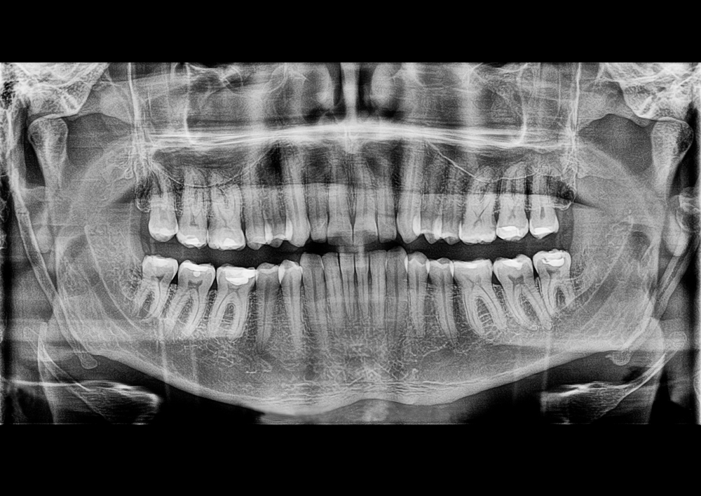 Dažniausiai pasitaikančios dantų šalinimo priežastys yra šios: