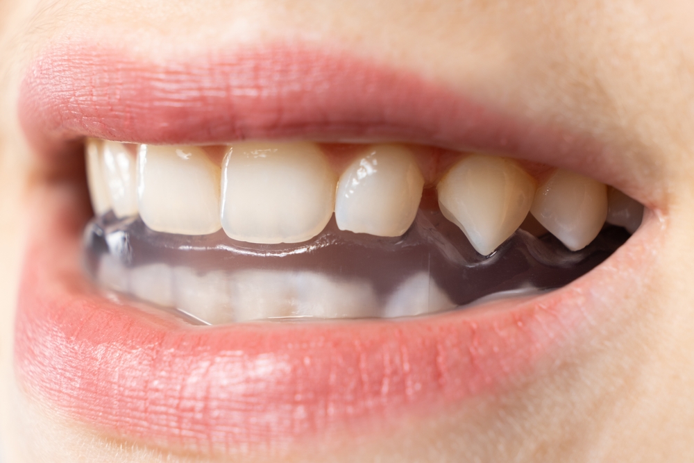 Dantų griežimo (bruksizmo) gydymo galimybės